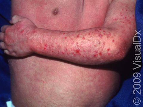 This image displays scratched skin lesions of a severe case of atopic dermatitis (eczema) in a young child.