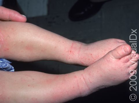 Atopic dermatitis (eczema) frequently affects skin folds, such as the front of the ankles.