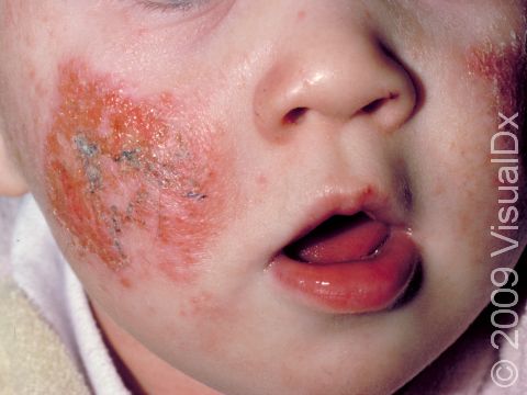 This image displays large, crusted lesions with erosions in a severe case of atopic dermatitis (eczema).