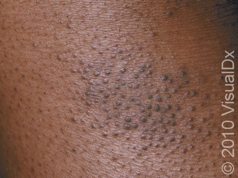 This image displays a close-up of brown, scaly, elevated follicles typical of atopic dermatitis (eczema).