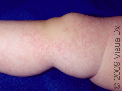 Atopic dermatitis (eczema) can have fine pink to red bumps and slightly elevated lesions.