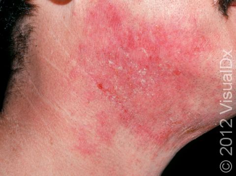 In adults, atopic dermatitis can frequently involve the neck and cheeks.