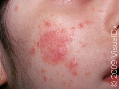 Red or pink, scaling lesions and dry-appearing skin are typical in atopic dermatitis (eczema).