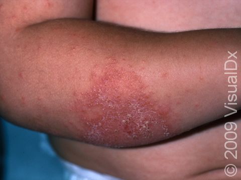This image displays scaling, dry, slightly elevated lesions typical of atopic dermatitis (eczema).