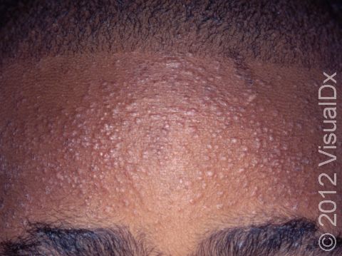 Atopic dermatitis (eczema) in darker-skinned children is often accentuated around hair follicles, giving a bumpy appearance.