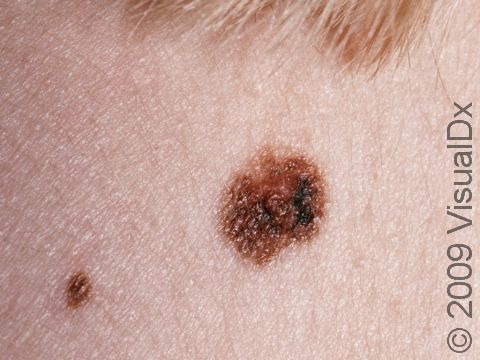 This image displays an atypical nevus (mole) with deep and multiple colors and an irregular border.