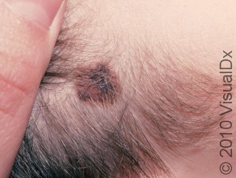 As displayed in this image, atypical nevi (moles) usually have variation in color.