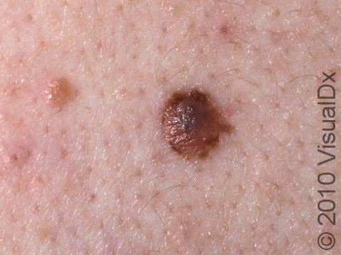 This image displays pigmented skin that happens to be an abnormal mole, but a lesion that has this variation in color should be biopsied to verify it's not melanoma.