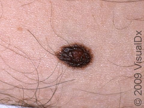 This image displays a black and red atypical nevus.