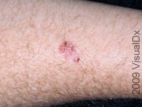 This image displays a scaly, red, round lesion with crusts typical of basal cell carcinoma.
