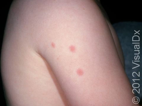 What Does A Single Bed Bug Bite Look Like Infoupdate