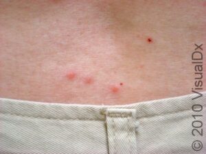 Bedbug Bite: Symptoms, Treatment, and Prevention