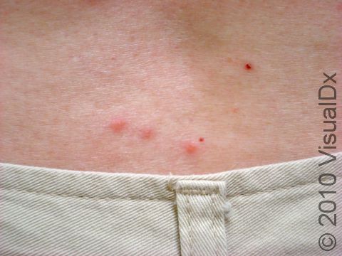 Bedbug bites can often be found in a line or arc on the skin, commonly known as 