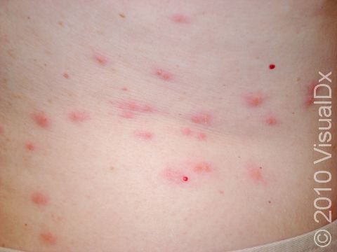 Red, intensely itchy bumps can be seen on the lower back of this man with bedbug bites.