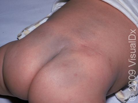 Blue-gray spots (congenital dermal melanocytosis) appear as gray-to-blue-colored, flat, 