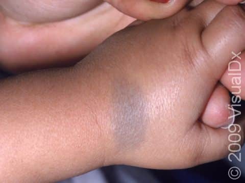 Blue-gray spots (congenital dermal melanocytosis) typically occur on the trunk. Here, however, is a small area involving the hand.