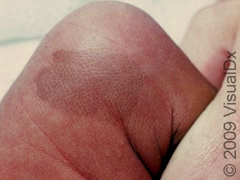 This image displays a newborn with a brown, flat area of pigment near the knee typical of café au lait macules.