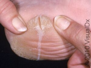 Callus Condition, Treatments and Pictures for Adults - Skinsight