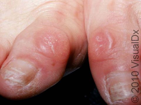 This image displays calluses at the tops of both great toes as well as toenail changes from repeated pressure.