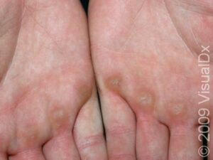 Callus Condition, Treatments and Pictures for Adults - Skinsight