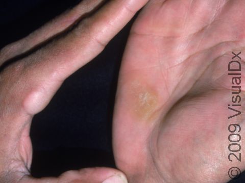 Calluses develop wherever the skin is exposed repeatedly to pressure or friction, as displayed on these hands.