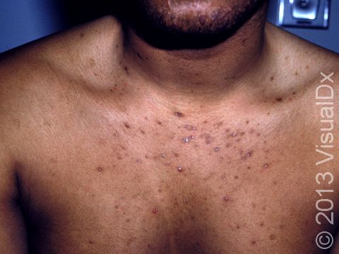 Candida (yeast) infections often cause small bumps (papules), which sometimes contain pus.