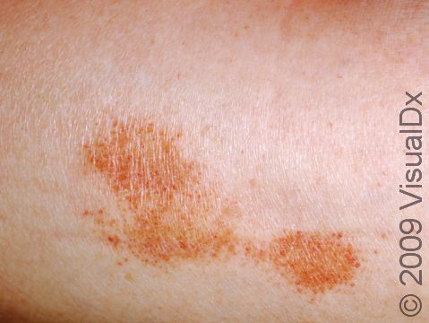 This image displays cayenne-pepper colored skin lesions typical of capillaritis.