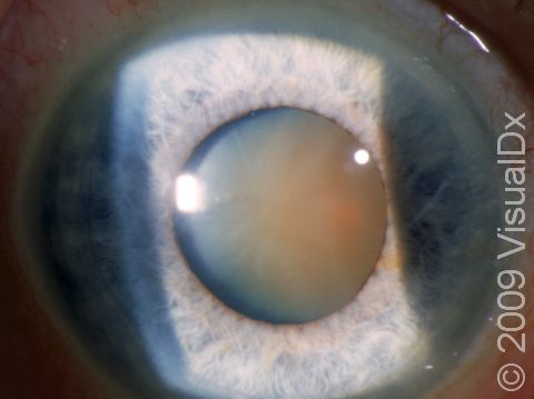 The gray, off-white color of the lens in this dilated pupil displays the appearance typical of cataract.