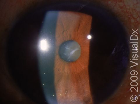 This undilated pupil displays the gray-white appearance of a cataractous lens.