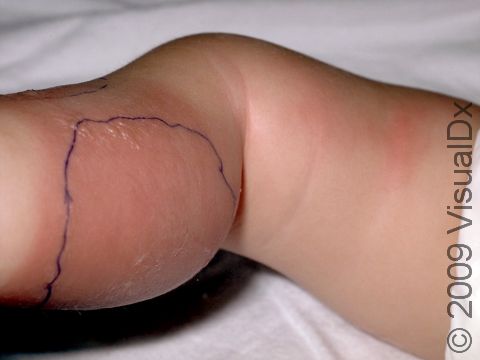 This image displays blisters and redness ascending up the leg typical of cellulitis, a soft tissue bacterial infection.