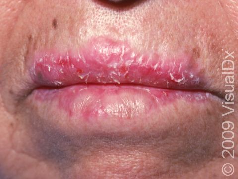 This image displays dryness and inflammation typical of cheilitis.