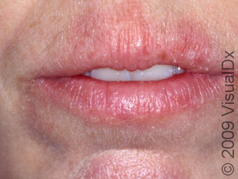 Chapped lips (cheilitis) are lips that are inflamed, scaly, and cracked. Chapped lips may be due to an allergy, irritation, or excessive dryness.