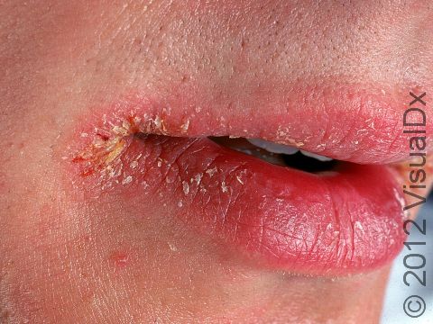This image displays lips that are inflamed, scaly, and cracked due to cheilitis, which can be due to allergy, irritation, or excessive dryness.