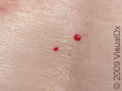 Cherry hemangiomas occur on normal skin, meaning the skin surrounding the cherry hemangioma does not change.