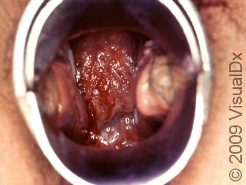 This image displays a woman's cervix with red erosions due to a chlamydial infection.