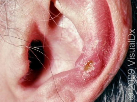 Chondrodermatitis nodularis helicis affects the ear. Sometimes there is a small skin ulcer in the center of the papule, as seen here.