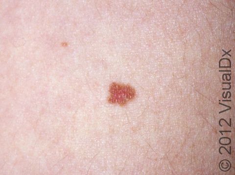 This small reddish-brown, slightly elevated lesion is a benign mole.