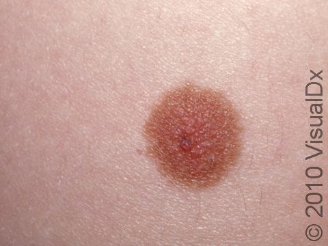 Normal nevi (moles) are usually light brown and regular in color and shape.