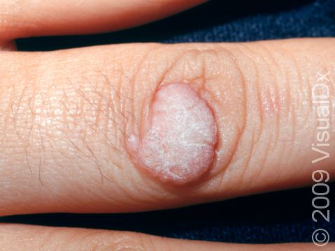 This image displays a wart on a finger.