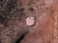 Genital Wart (Condyloma Acuminatum) – Adult