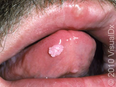 This image displays how condyloma (genital warts) can be transferred to the mouth by oral sex.