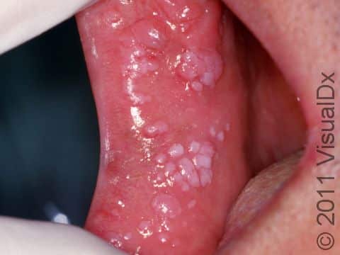 Genital warts can involve the oral mucosa. Warts often have a white appearance in the mouth and can be in groups, as seen here.