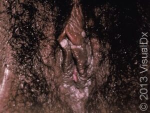 Genital Wart (Condyloma Acuminatum) Condition, Treatments and Pictures ...