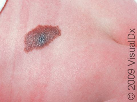 This image displays a congenital nevus with a black area, which should be evaluated by a dermatologist due to the possibility of melanoma.