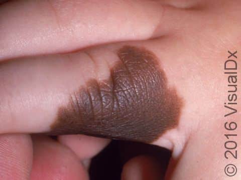 A congenital melanocytic nevus (birthmark) usually has sharply defined edges and an even brown color.