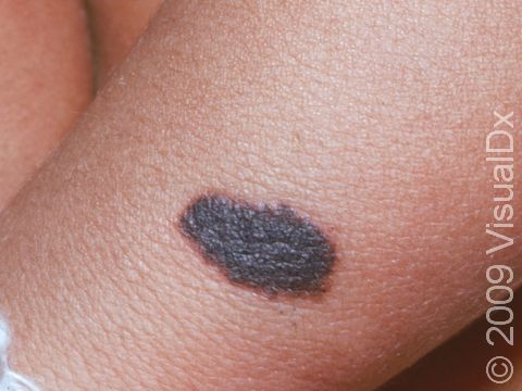 This image displays a close-up of a congenital nevus that is uniformly black.