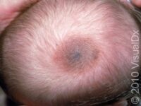 Birthmark (Congenital Melanocytic Nevus)