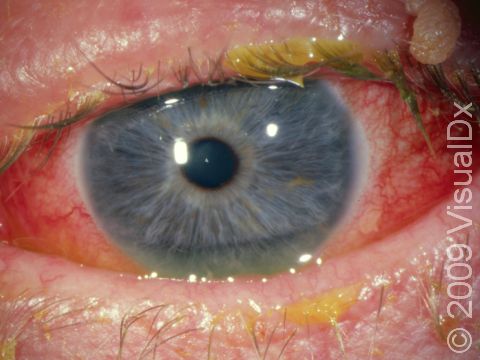 This is the most typical appearance of conjunctivitis, with redness of the eye and mucoid debris on the eyelashes.