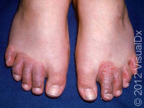 This image displays redness and scaling with a sharp boundary around the affected area typical to contact allergic dermatitis.