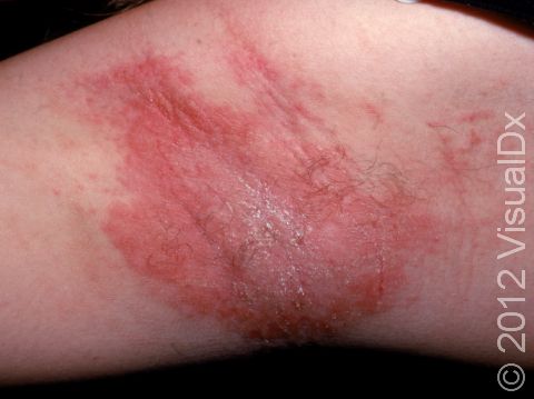 Allergic Contact Dermatitis Condition Treatments and Pictures for